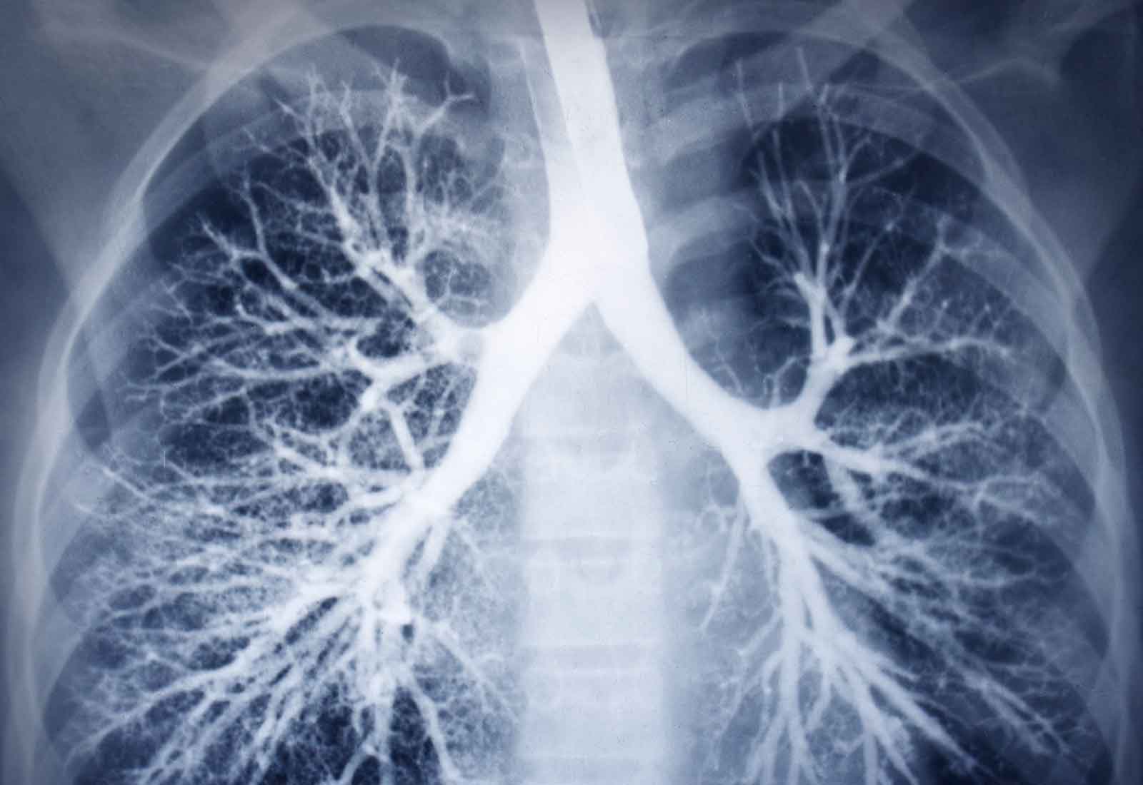 Lung Cancer Research Projects