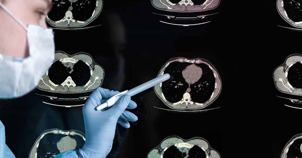 When lung repair goes wrong